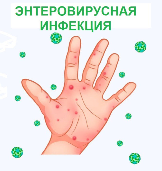Энтеровирусная инфекция
